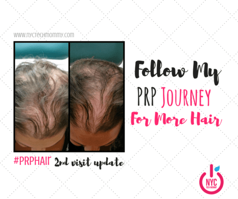 Almost 56 million Americans deal with hair loss every day and 40% of them are women. Are you one of them? Follow my #PRP Hair Treatment Journey for more hair!
