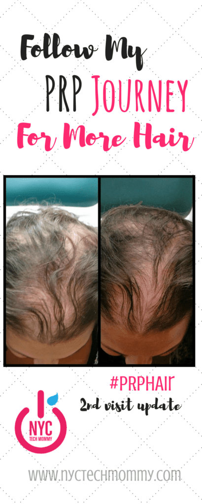 Almost 56 million Americans deal with hair loss every day and 40% of them are women. Are you one of them? Follow my #PRP Hair Treatment Journey for more hair!