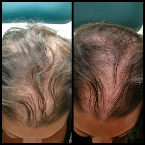 Almost 56 million Americans deal with hair loss every day and 40% of them are women. Are you one of them? Follow my #PRP Hair Treatment Journey for more hair!