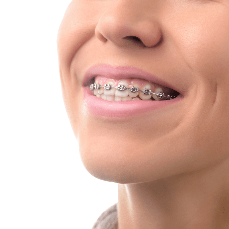 prevent tooth decay in kids with braces