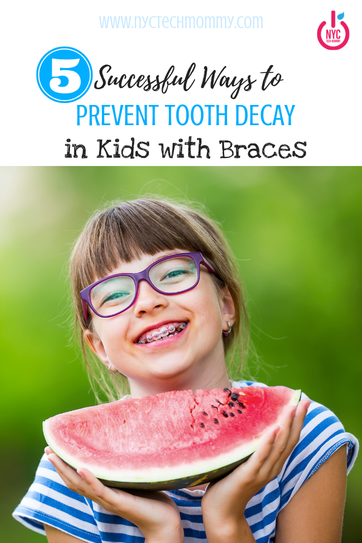 Tips to help you prevent tooth decay in kids with braces.  #braces #smile #kidsteeth